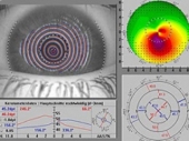 Lečenje keratokonusa u Laser fokusu