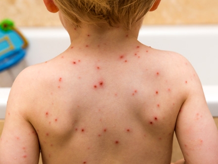 Dete nije bilo vakcinisano FOTO: Getty Images/ilustracija