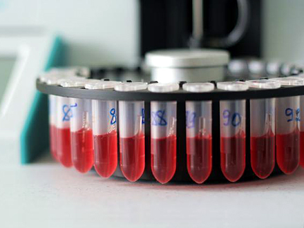 Krvnu plazmu je doniralo 11 pacijenata FOTO: Thinkstock