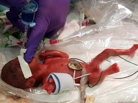 Imala samo 212 grama kada se rodila FOTO: AFP
