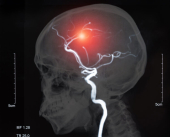 Simptomi aneurizme mozga koje ne treba ignorisati